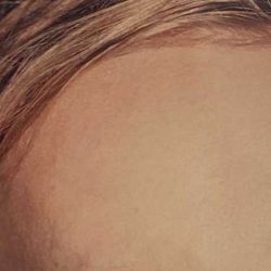 Botox Before & After Patient #2160