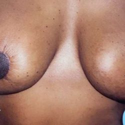 Breast Lift Before & After Patient #2297