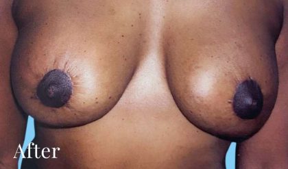 Breast Lift Before & After Patient #2297
