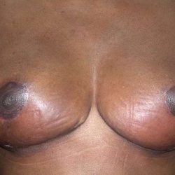 Breast Reduction Before & After Patient #2363