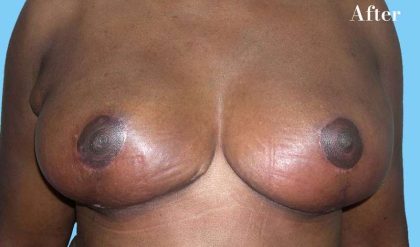 Breast Reduction Before & After Patient #2363