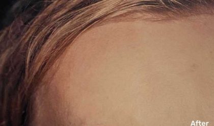 Botox Before & After Patient #2160