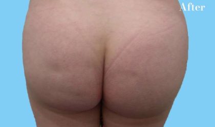 Buttock Augmentation Before & After Patient #2462