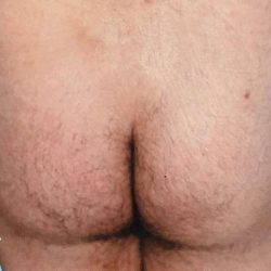 Buttock Augmentation Male Before & After Patient #2474