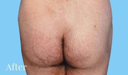 Buttock Augmentation Male Before & After Patient #2474