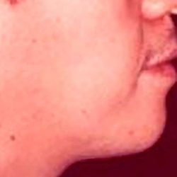 Chin Implants Before & After Patient #2483