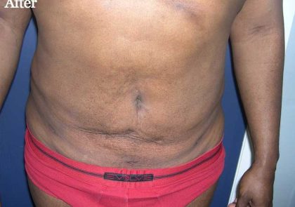 Daddy Makeover Before & After Patient #2527