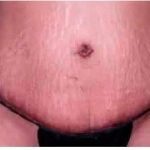 Mommy Makeover Before & After Patient #2944