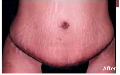 Mommy Makeover Before & After Patient #2944