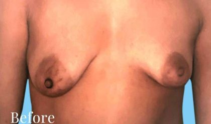 Breast Asymmetry Correction Before & After Patient #2187
