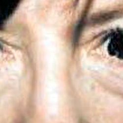 Eyelid Surgery Before & After Patient #2626