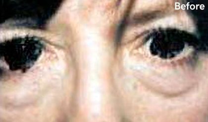 Eyelid Surgery Before & After Patient #2626
