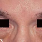 Eyelid Surgery Male Before & After Patient #2638