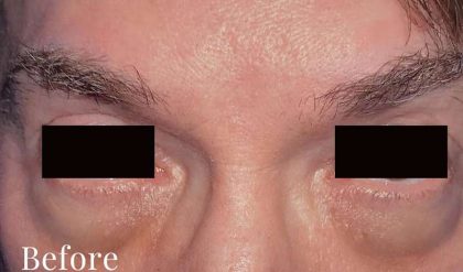 Eyelid Surgery Male Before & After Patient #2638