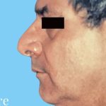 Facelift Male Before & After Patient #2674