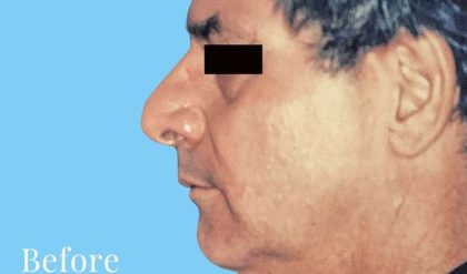 Facelift Male Before & After Patient #2674
