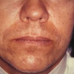 Fat Transfer Male Before & After Patient #2695
