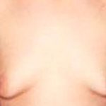 Gynecomastia Before & After Patient #2722