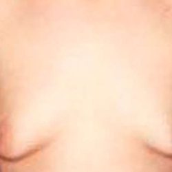 Gynecomastia Before & After Patient #2722
