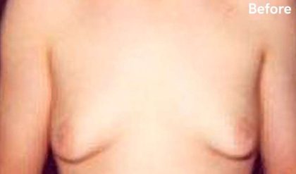 Gynecomastia Before & After Patient #2722