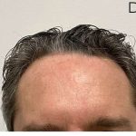 Hair Restoration Before & After Patient #2802
