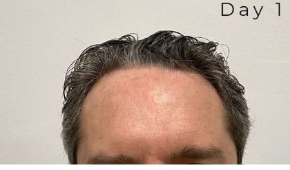 Hair Restoration Before & After Patient #2802