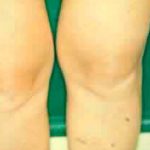 Liposuction Before & After Patient #2885