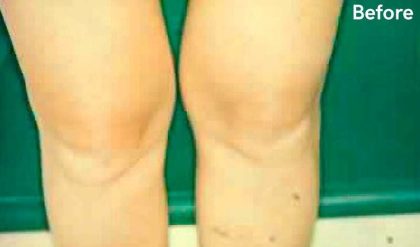Liposuction Before & After Patient #2885
