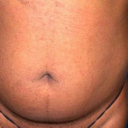 Liposuction Male Before & After Patient #2918
