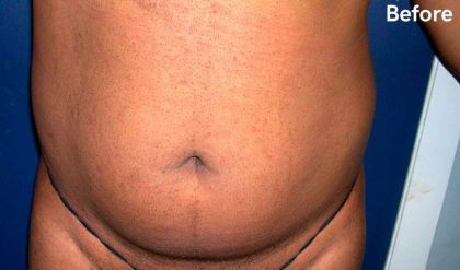 Liposuction Male Before & After Patient #2918