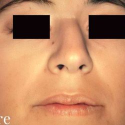 Rhinoplasty Before & After Patient #3003