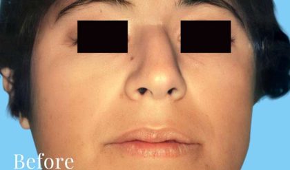 Rhinoplasty Before & After Patient #3003