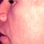 Rhinoplasty Male Before & After Patient #3039
