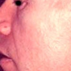 Rhinoplasty Male Before & After Patient #3039