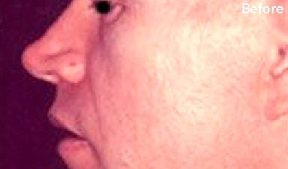 Rhinoplasty Male Before & After Patient #3039