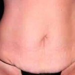 Tummy Tuck Before & After Patient #3078