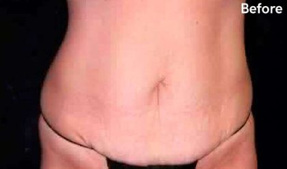 Tummy Tuck Before & After Patient #3078