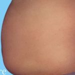 Tummy Tuck Male Before & After Patient #3090