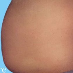 Tummy Tuck Male Before & After Patient #3090