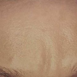 Botox Before & After Patient #2160
