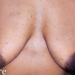 Breast Lift Before & After Patient #2297