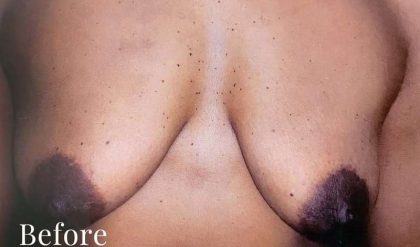 Breast Lift Before & After Patient #2297