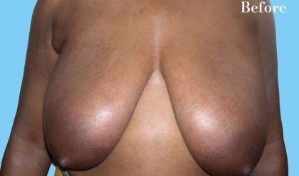 Breast Reduction Before & After Patient #2363