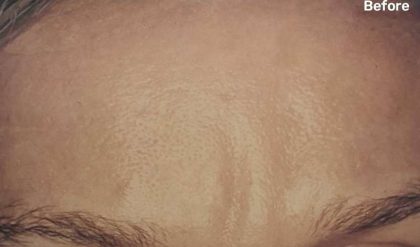 Botox Before & After Patient #2160