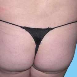 Buttock Augmentation Before & After Patient #2462