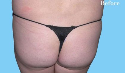 Buttock Augmentation Before & After Patient #2462