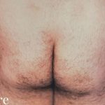 Buttock Augmentation Male Before & After Patient #2474