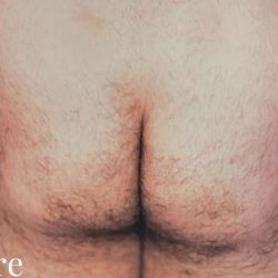 Buttock Augmentation Male Before & After Patient #2474