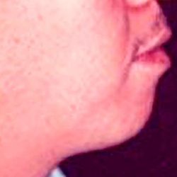 Chin Implants Before & After Patient #2483