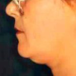 Chin Liposuction Before & After Patient #2495